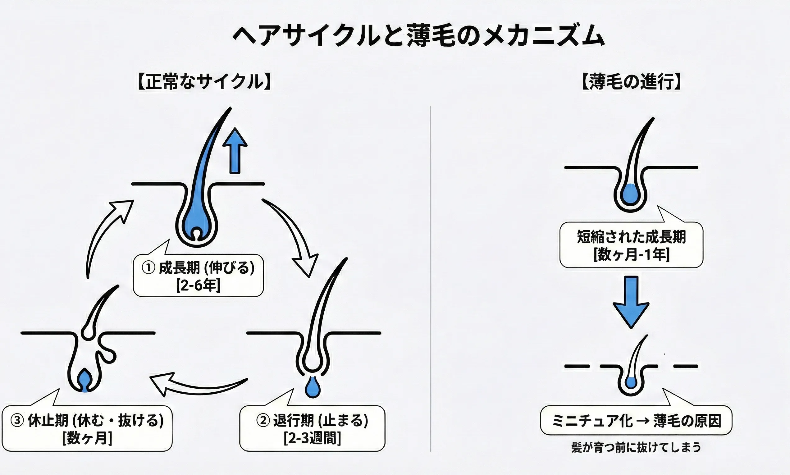 ヘアサイクルの仕組み図解 - 成長期・退行期・休止期・脱毛期の4段階サイクルとAGAによる成長期短縮のメカニズム